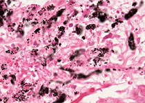 Toxoplasmosis